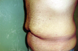 Abdominoplasty Procedure