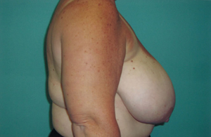 Breast reduction before photo