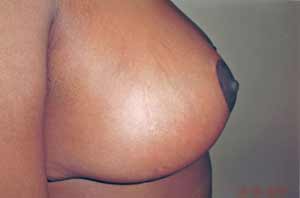 Breast reduction post treatment photo
