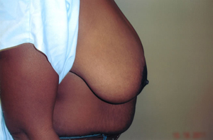 Breast reduction before photo